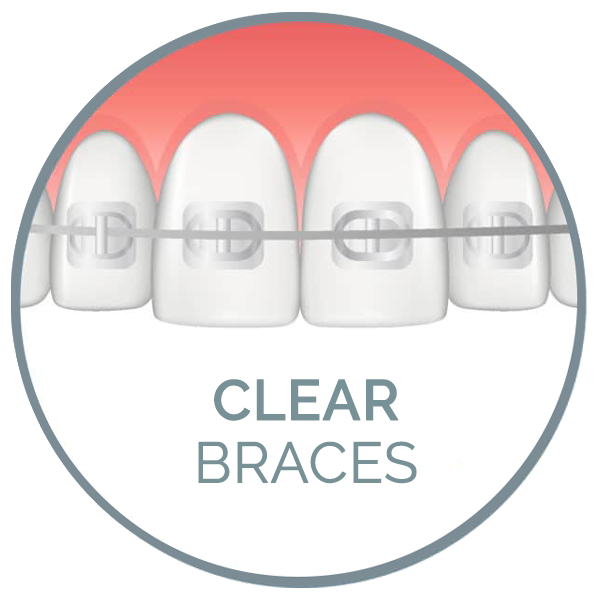 clear aligners