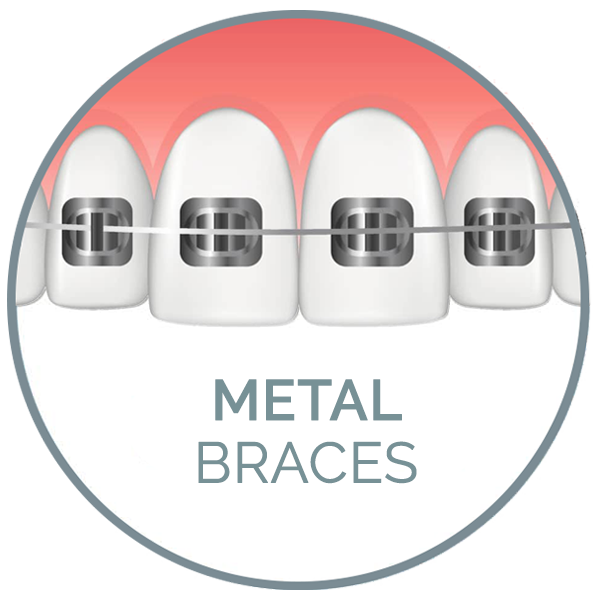 metal braces