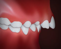 Upper Front Teeth Protrusion